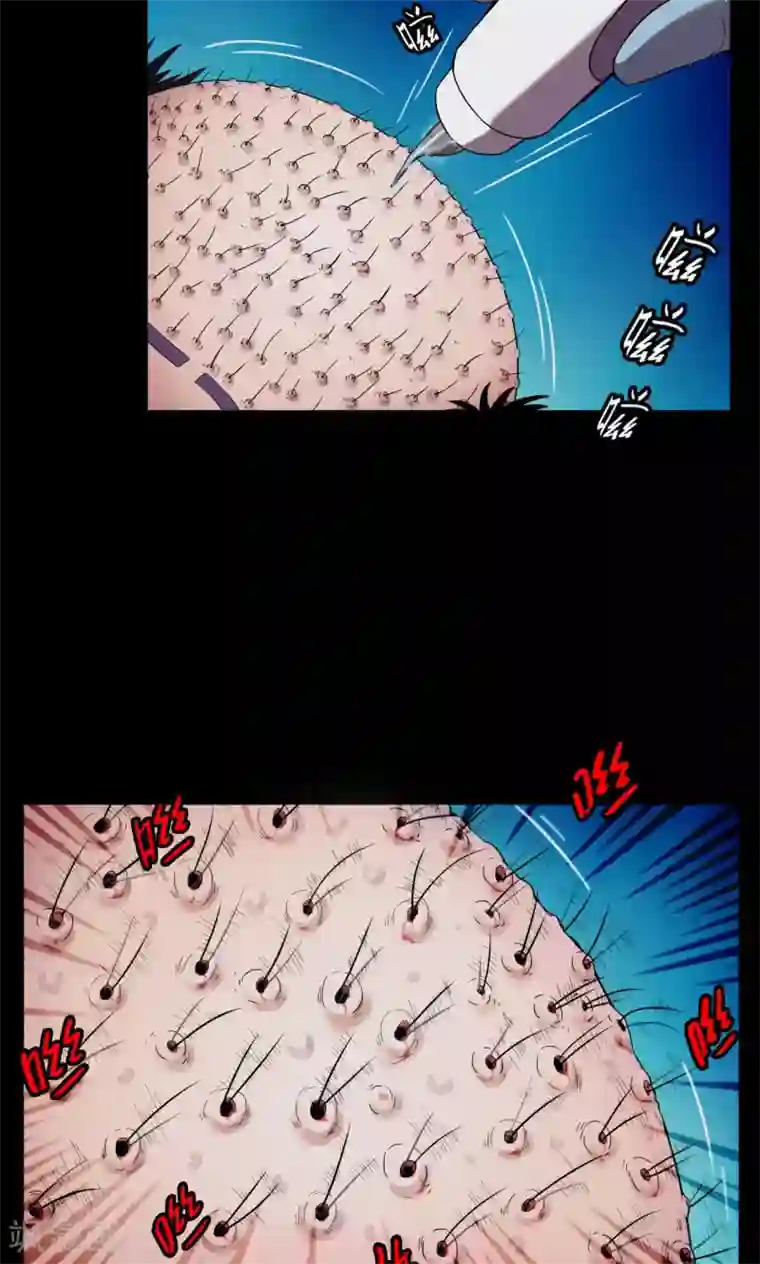 密集黑洞第19话 植发4